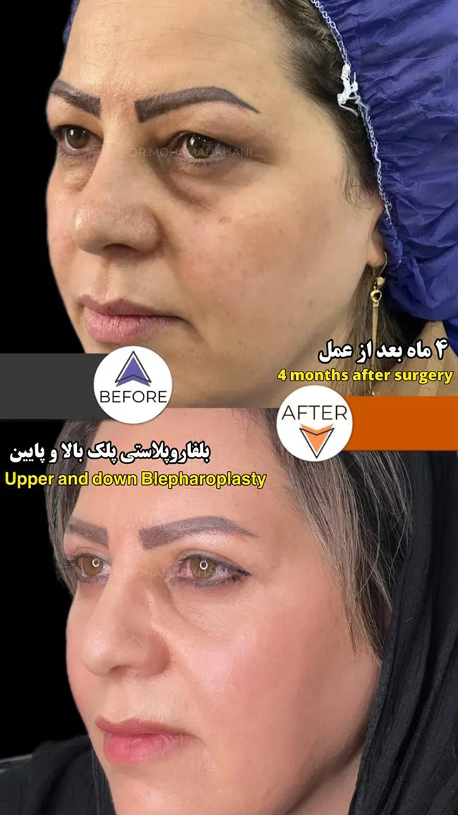 Lower Eyelid Blepharoplasty