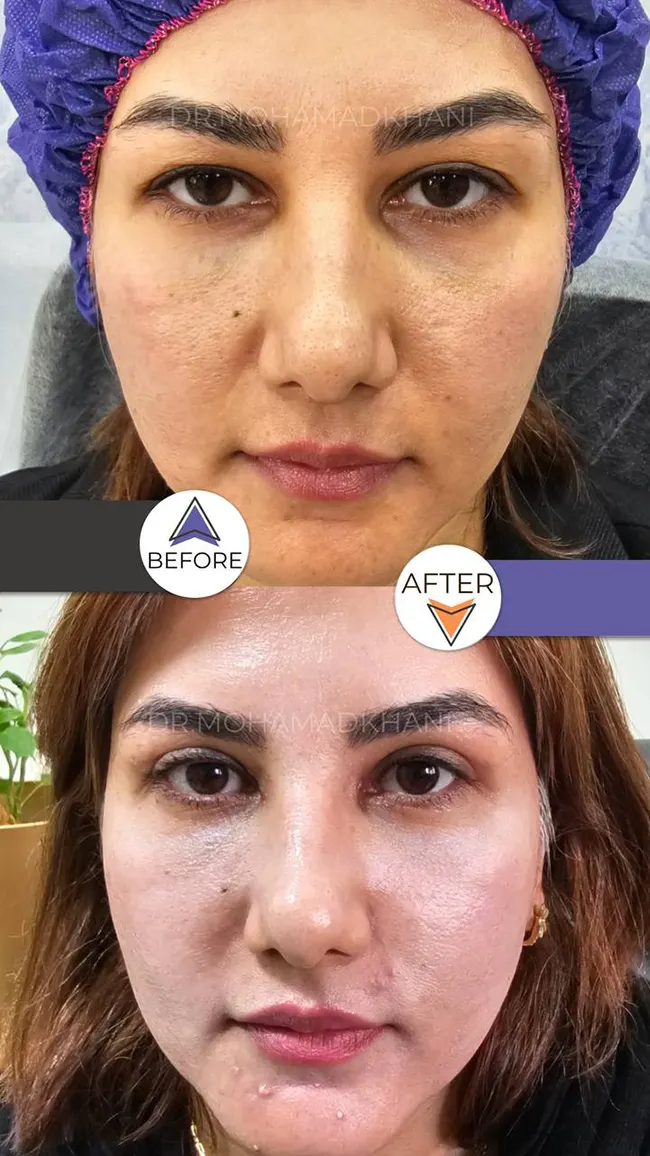 Upper Eyelid Blepharoplasty