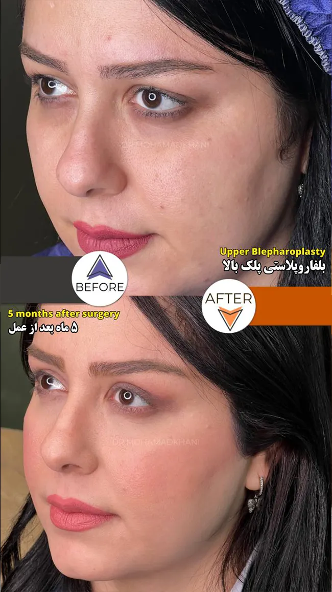 Upper Eyelid Blepharoplasty