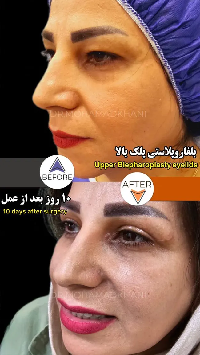 Upper Eyelid Blepharoplasty