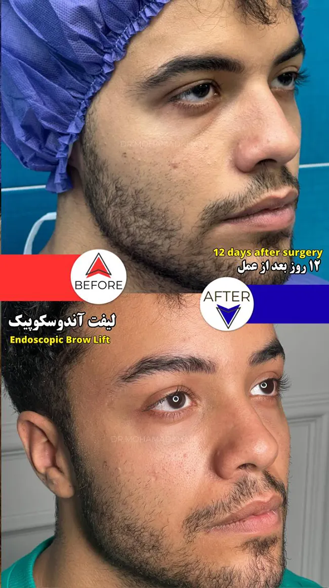 Endoscopic Temple Lift