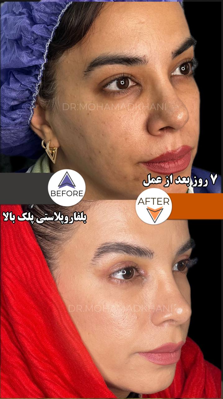Upper Eyelid Surgery