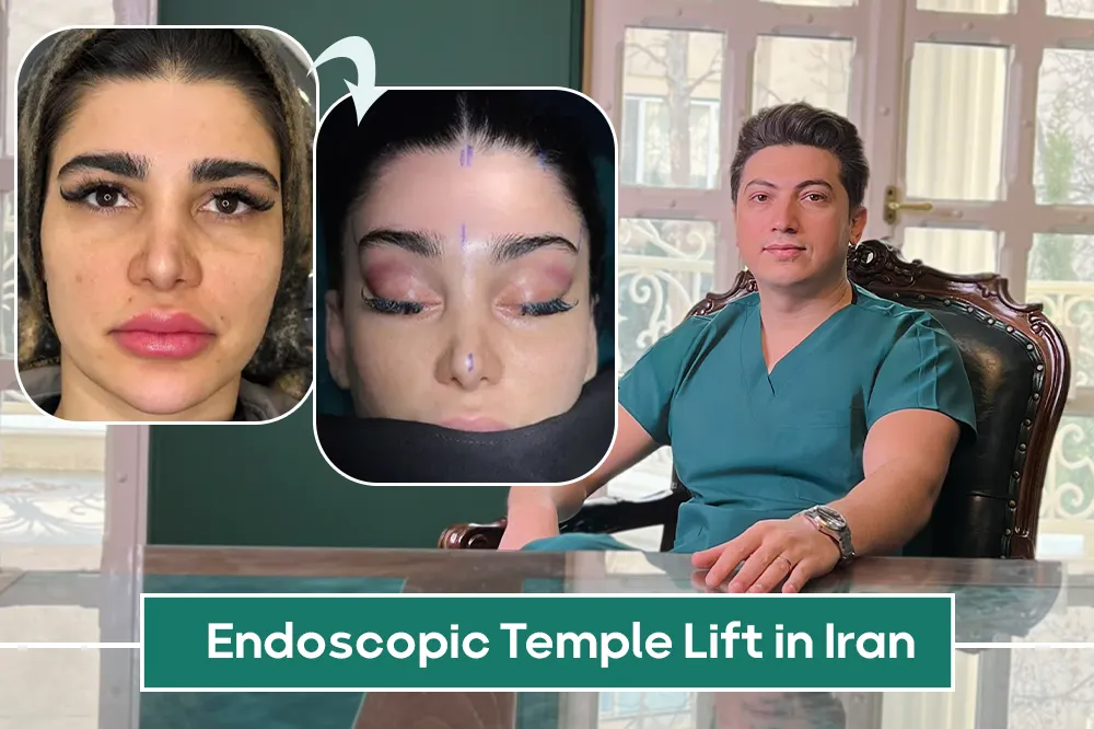 Endoscopic Temple Lift in Iran