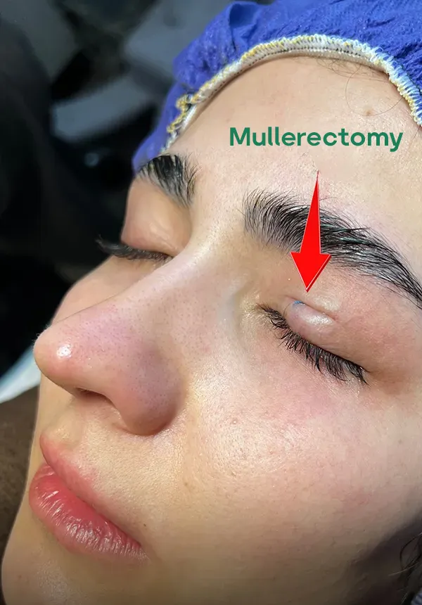 Mullerectomy