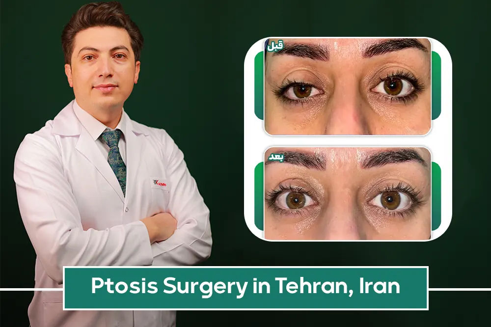 Ptosis Surgery in Tehran, Iran