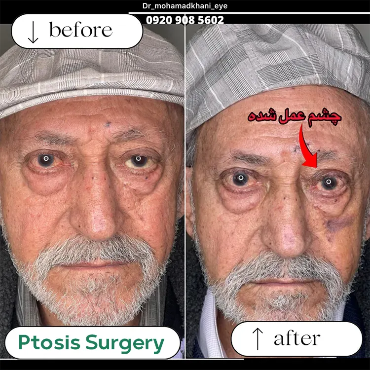 Ptosis Surgery