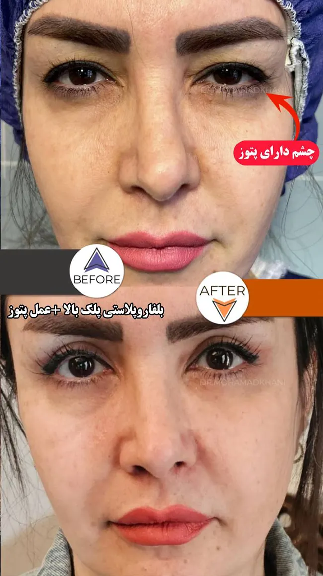Ptosis Surgery