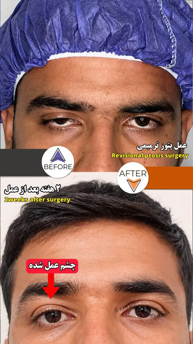 Ptosis Surgery