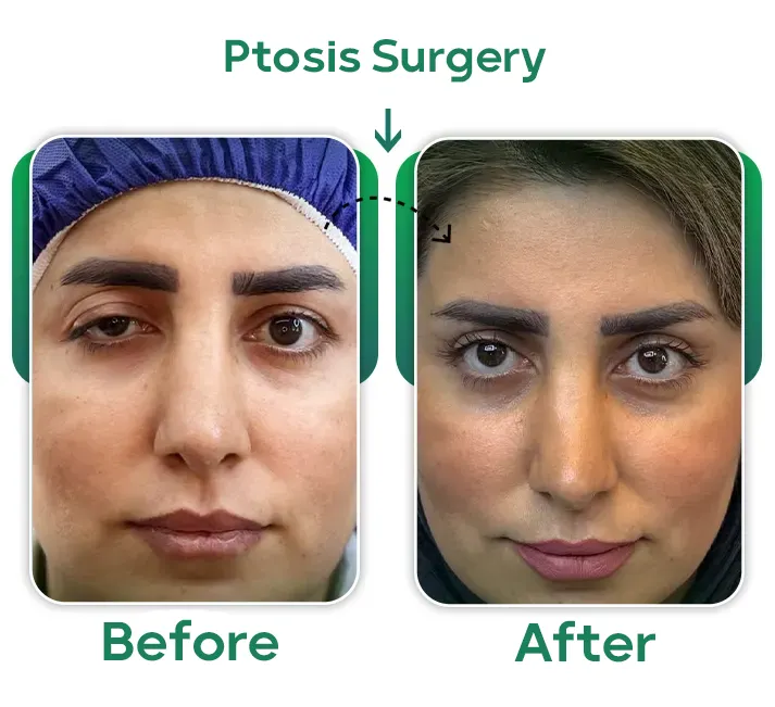 Ptosis Surgery